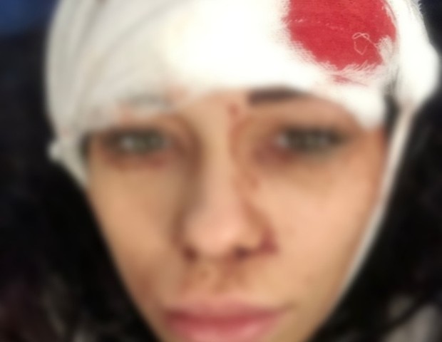 Anastasia mostra como ficou após a briga (Foto: NOTÍCIAS EAST2WEST)