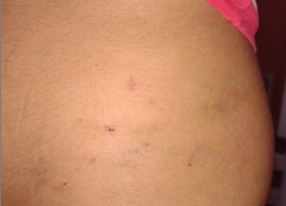 Jovem publicou imagens de marcas que ficaram em seu corpo nas redes sociais — Foto: Reprodução/Instagram