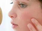 Ter acne pode ser sinal de pele mais jovem no futuro, diz estudo

