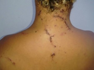 Garçom foi espancado e sofreu vários cortes nas costas (Foto: Arquivo pessoal)