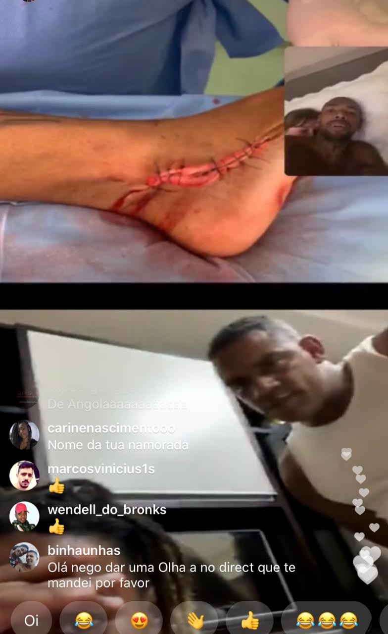 Nego do Borel mostra ferimento causado por acidente (Foto: Reprodução/ Instagram)