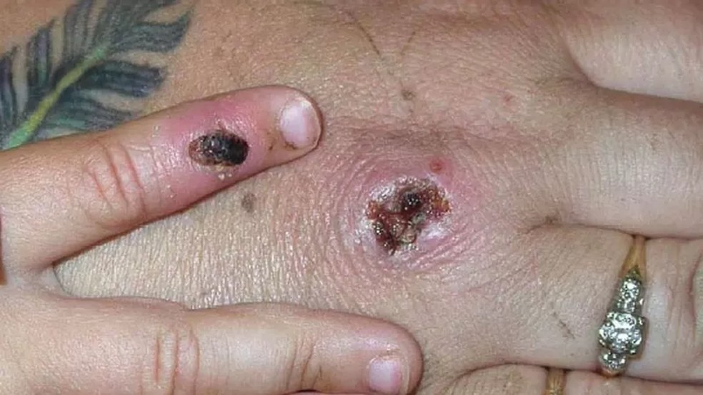 Fique atento aos sintomas da varíola doa macacos — Foto: Getty Images