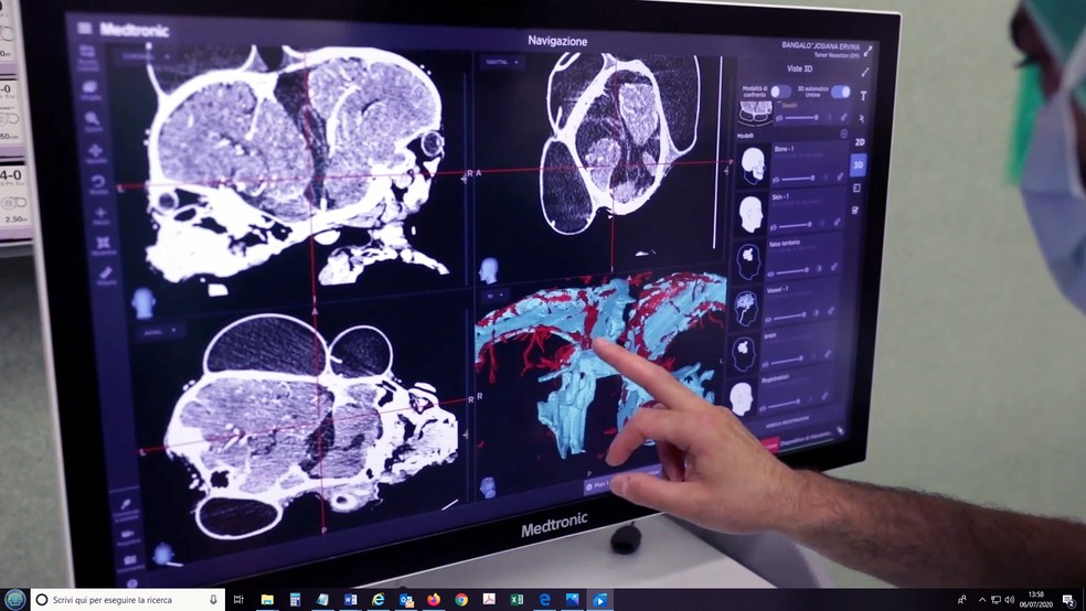 Um monitor mostra a reconstrução em 3D dos crânios das irmãs gêmeas Ervina e Prefina, que nasceram unidas na parte de trás da cabeça, em foto divulgada pelo hospital Bambino Gesú em Roma, na Itália, nesta quarta (8)  — Foto:  Ospedale Pediatrico Bambino Gesu/Divulgação via Reuters
