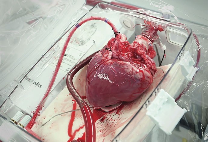 Oi, tum, tum: nova técnica possibilita o transplante de um coração parado há até 20 minutos (Foto: TransMedics)