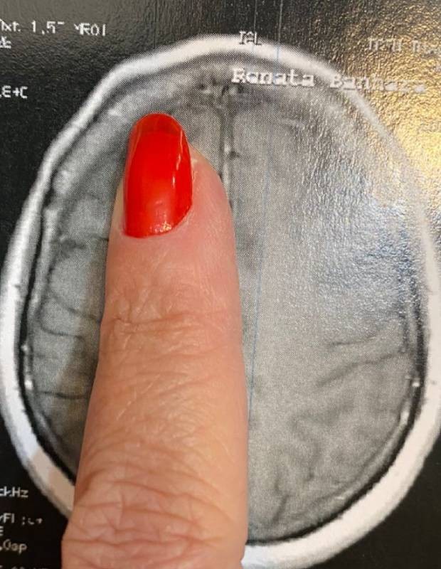 O tumor de Renata Banhara fica na parte de trás do cérebro, mas acaba causando um estufamento ósseo na testa (Foto: Arquivo pessoal)
