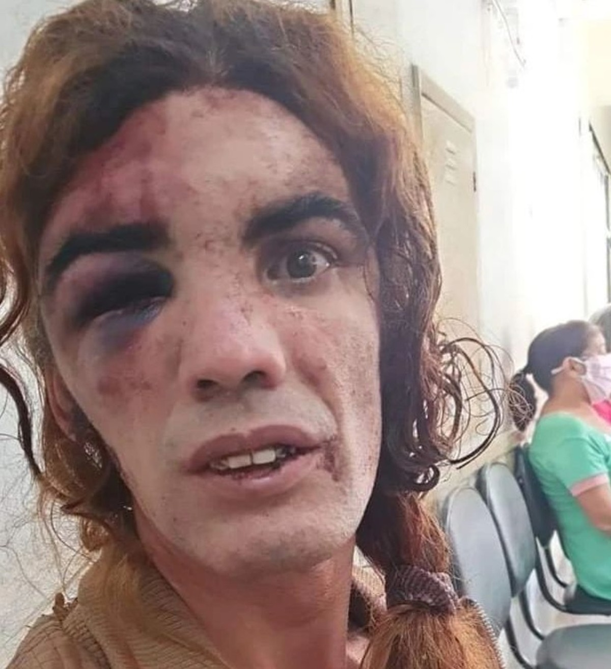 Mulher trans sofre trauma no rosto após ser agredida por homem em Sobradinho, no DF - G1