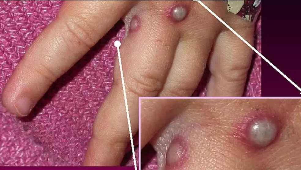 Entre os sintomas clássicos da varíola dos macacos estão as lesões na pele  — Foto: Getty Images/via BBC