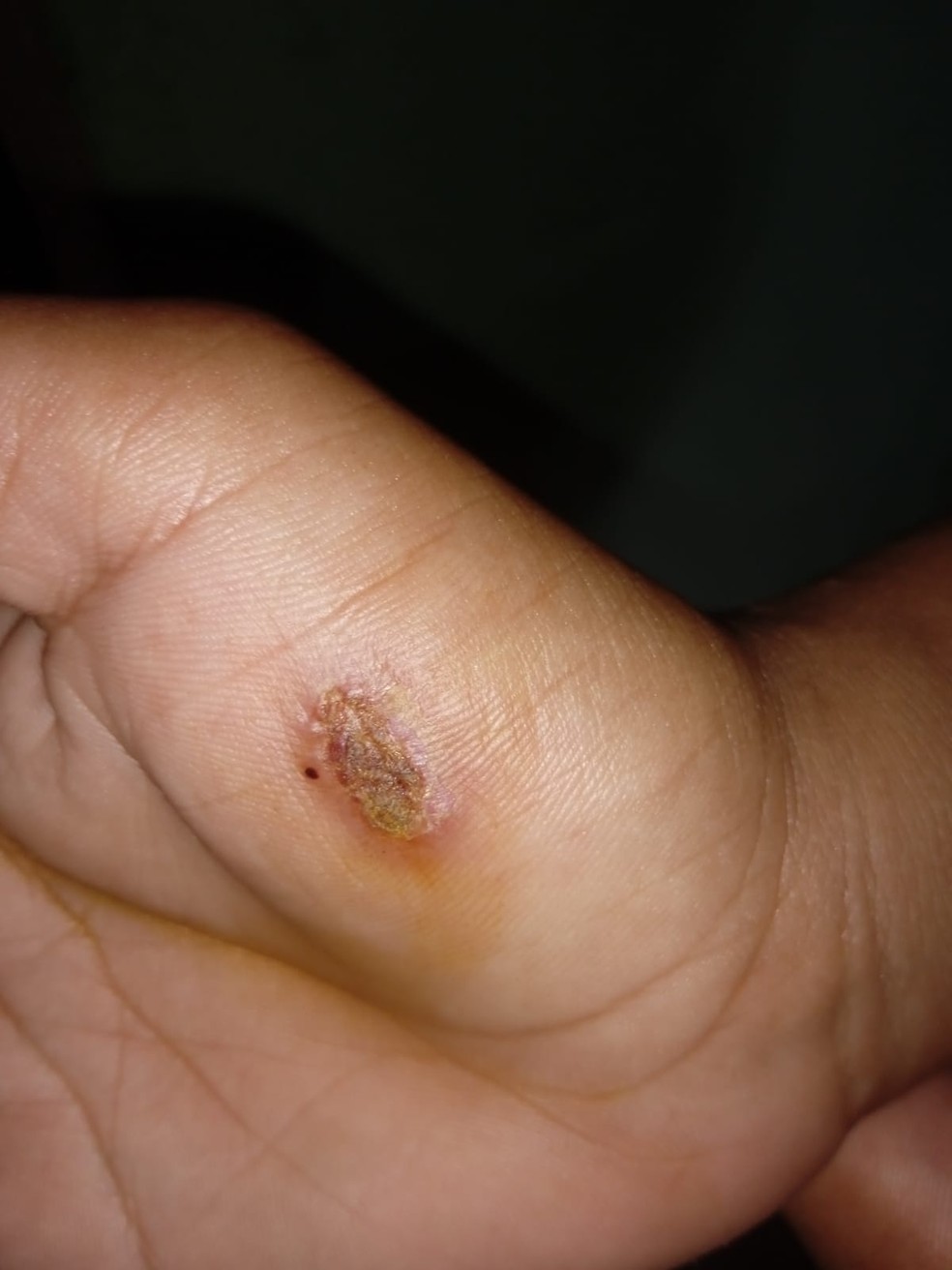 Lesão provocada por mordida em adolescente de 16 anos  — Foto: Divulgação/Polícia Civil