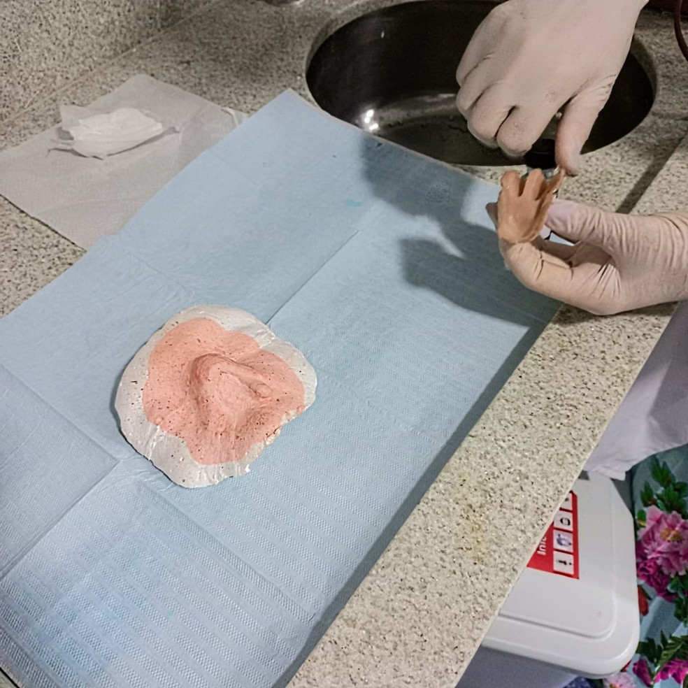 Prótese de nariz feita de silicone — Foto: Assessoria Hospital do Câncer/Divulgação