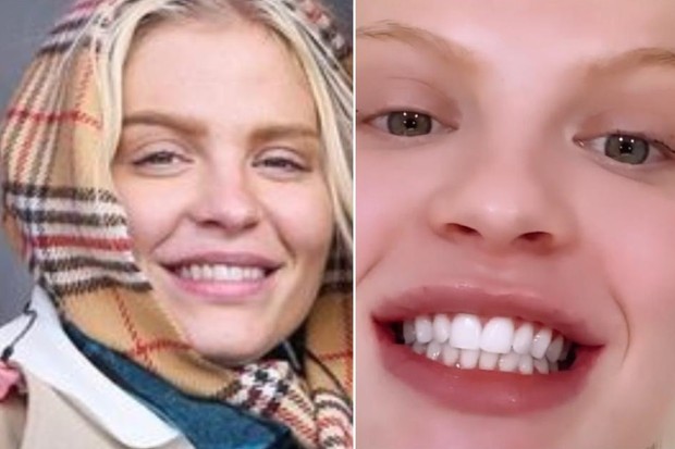 Luisa Sonza antes e depois de fazer clareamento nos dentes (Foto: Reprodução/ Instagram)
