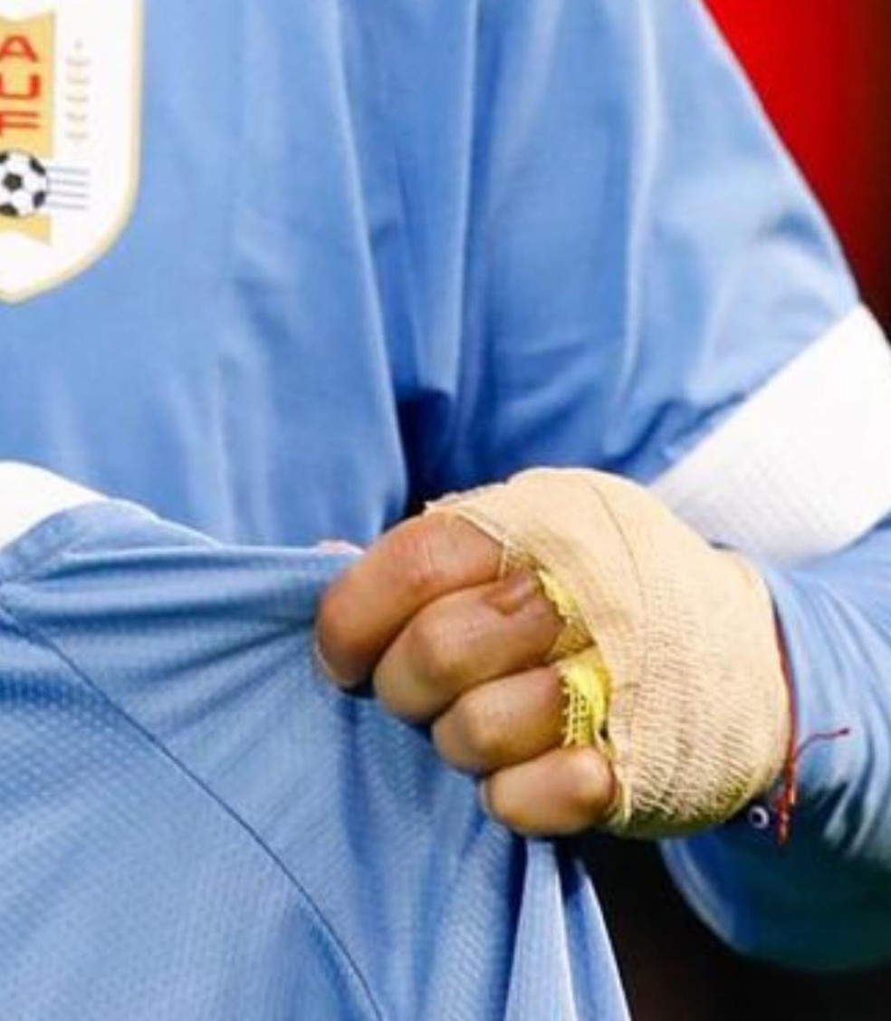 Arrascaeta com curativo na m&atilde;o por queimadura &mdash; Foto: Divulga&ccedil;&atilde;o