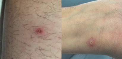 Lesões apresentadas pelo homem de 31 anos com varíola dos macacos em Portugal. (Foto: Reprodução/JACC: Case Reports)