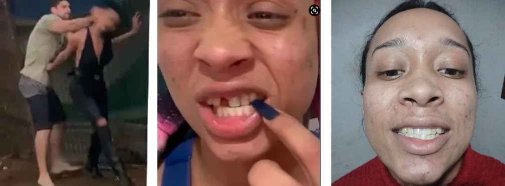 Priscyla Rodrigues foi agredida por um morador e teve o dente quebrado. Dentistas solidários ofereceram a reconstrução dele e um tratamento para ela — Foto: Reprodução/Redes sociais e Arquivo pessoal