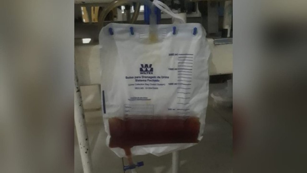 Escurecimento da urina é um dos sintomas da Síndrome de Haff, doença da urina preta — Foto: Reprodução/Redes sociais