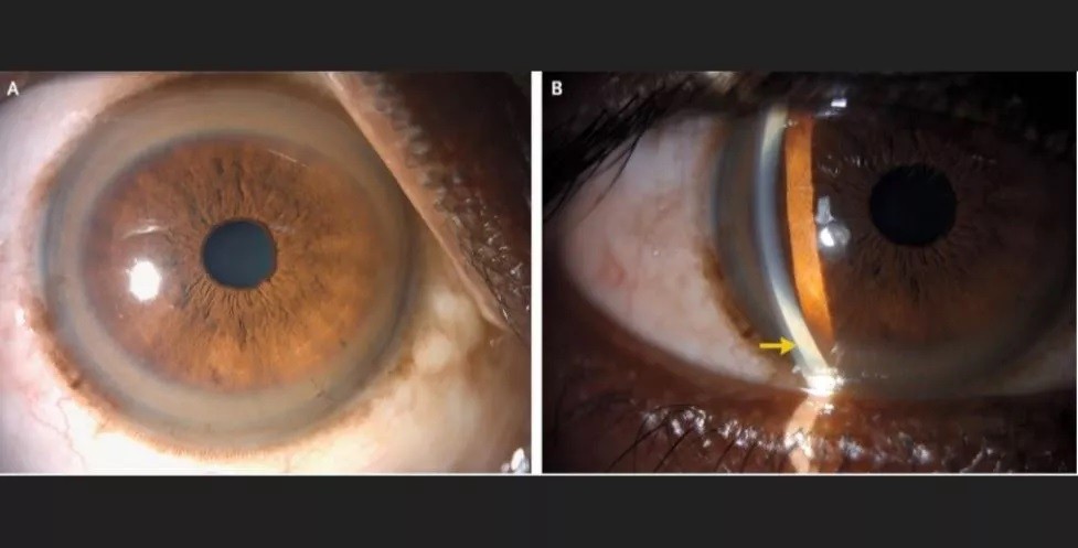 Homem que vive na Índia descobriu doença hereditária rara devido a arcos coloridos nos olhos (Foto:  The New England Journal of Medicine )