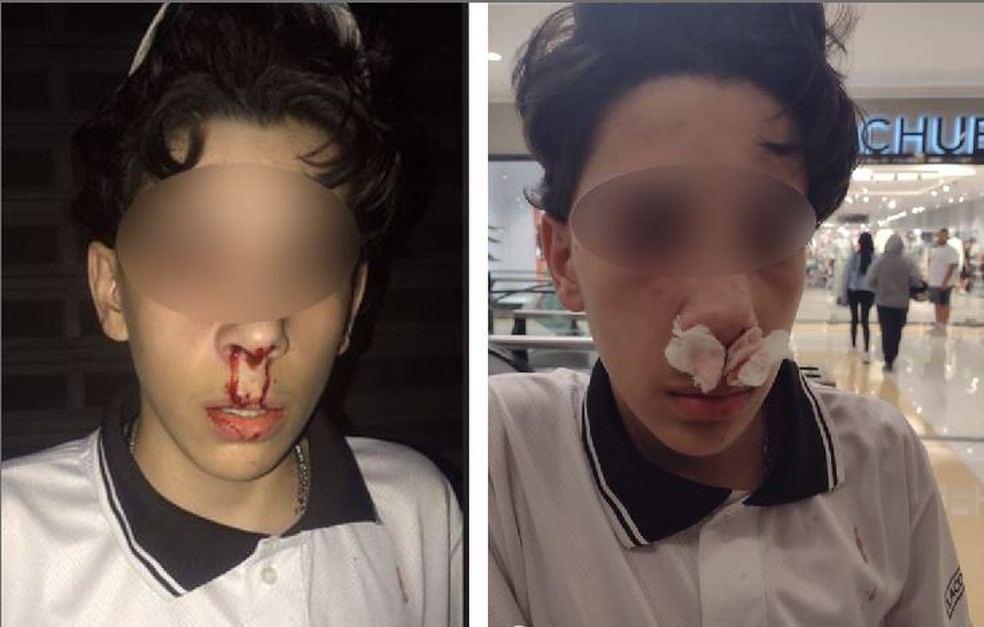 Garoto de 14 anos contou que segurança do shopping quebrou seu nariz — Foto: Reprodução/Arquivo pessoal/Redes sociais