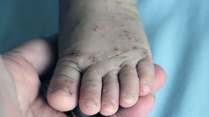 Sarna humana: conheça os sintomas e tratamentos para a escabiose (Foto: Ministério da Saúde)