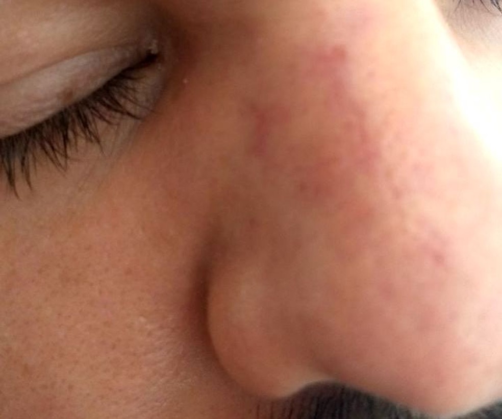 Namorado de 27 anos teve nariz fraturado em agressão na Lagoa da Conceição (Foto: Divulgação )