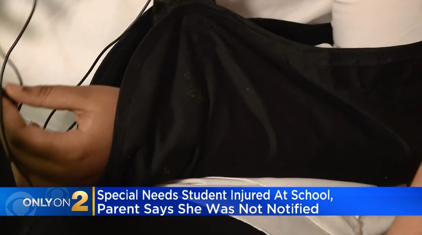 Menina chega em casa com a clavícula quebrada, sem que a mãe tenha sido avisada pela escola (Foto: Reprodução/CBS Chicago)