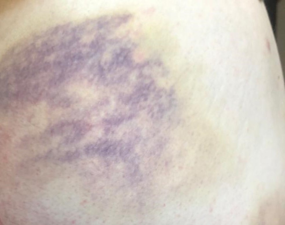 Denúncia afirma que um dos participantes do curso ficou com hematomas nas pernas e nádegas — Foto: Reprodução