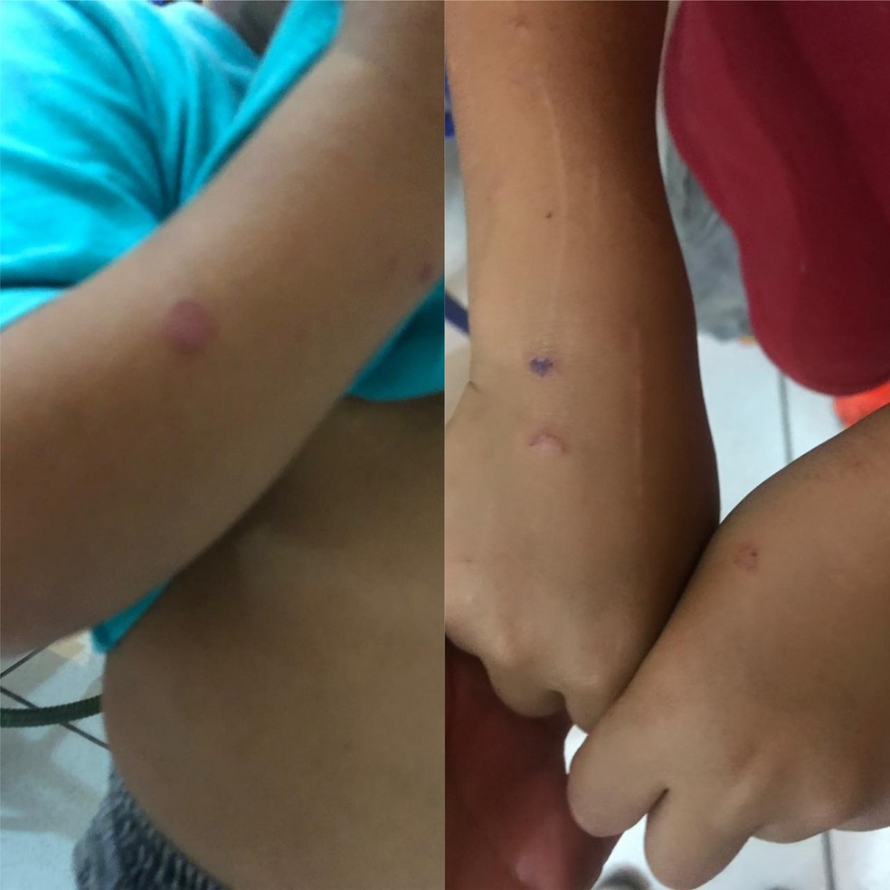 Meninos contaram à professora que a mãe os queimou com cigarro na mão  — Foto: Divulgação