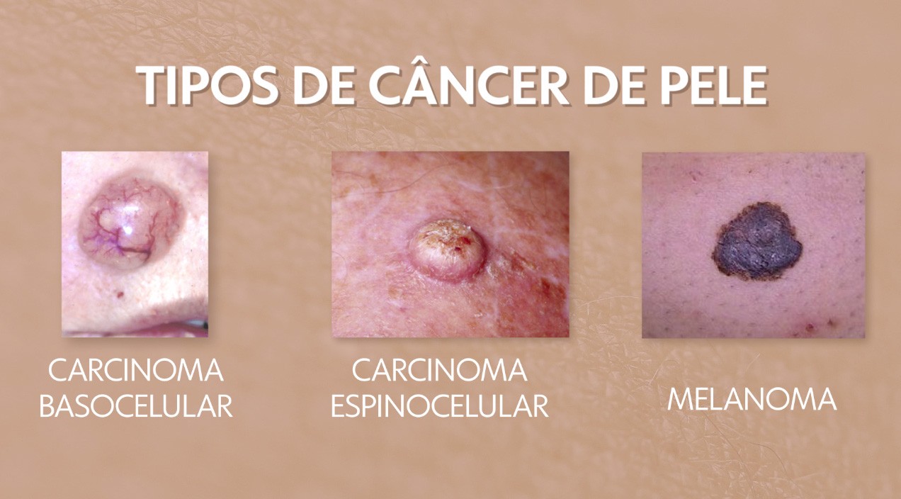 AME inicia atendimento para diagnóstico de câncer de pele e intestino a partir de 1º de julho nas regiões de Campinas e Piracicaba 