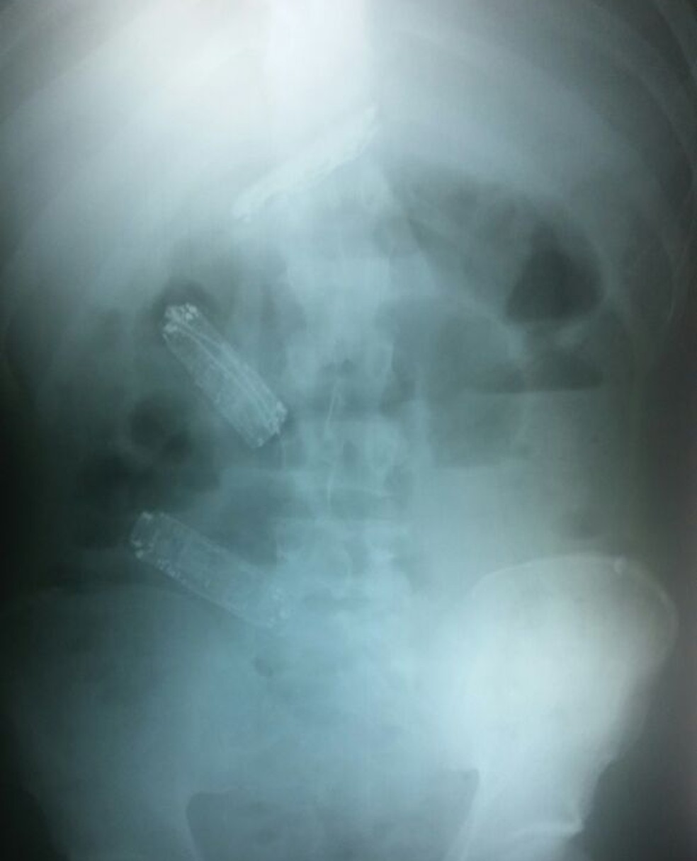 Preso tinha três celulares no estômago (Foto: SAP/Cedida)