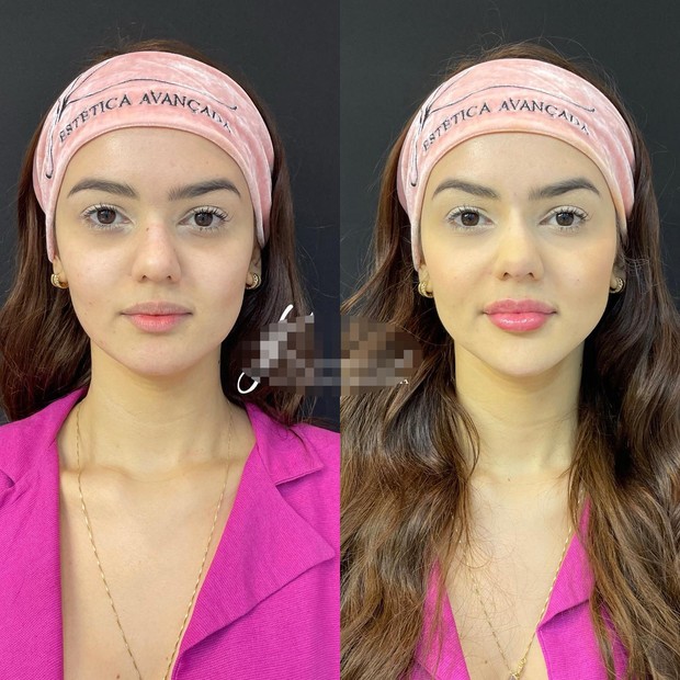 A ex-BBB Eslovênia antes e depois da segunda etapa de sua harmonização facial (Foto: Reprodução/Instagram)