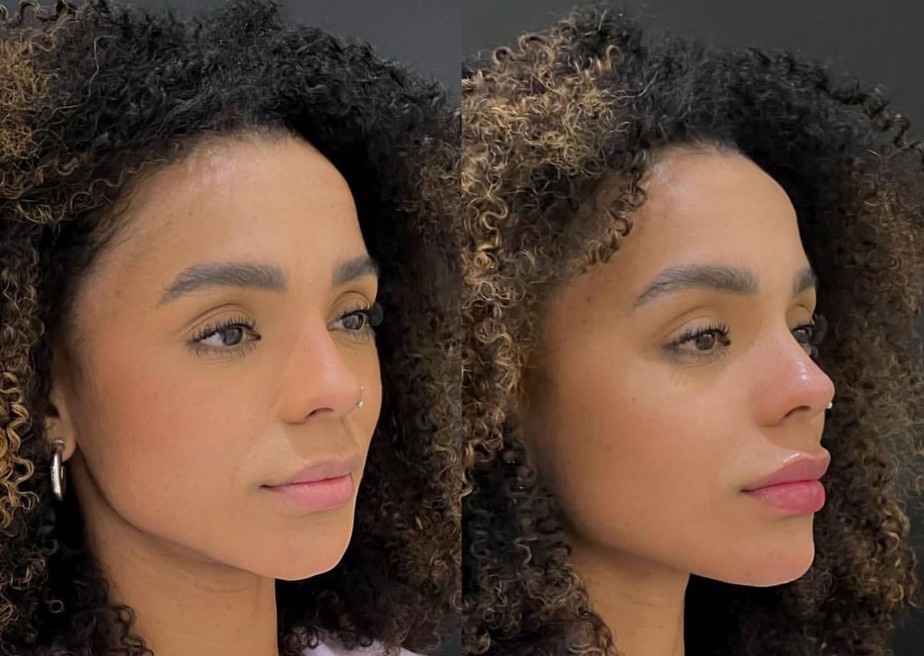 Antes e depois de harmonização facial de Brunna Gonçalves