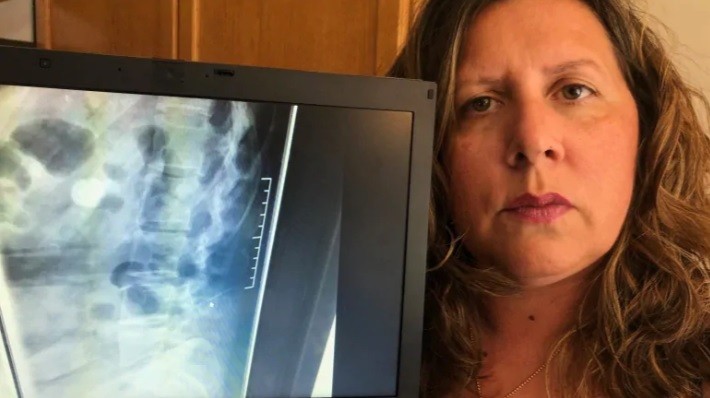 Giovanna Ippolito descobriu agulha na coluna em exame feito em 2018 (Foto: Reprodução/CBC News/Giovanna Ippolito )