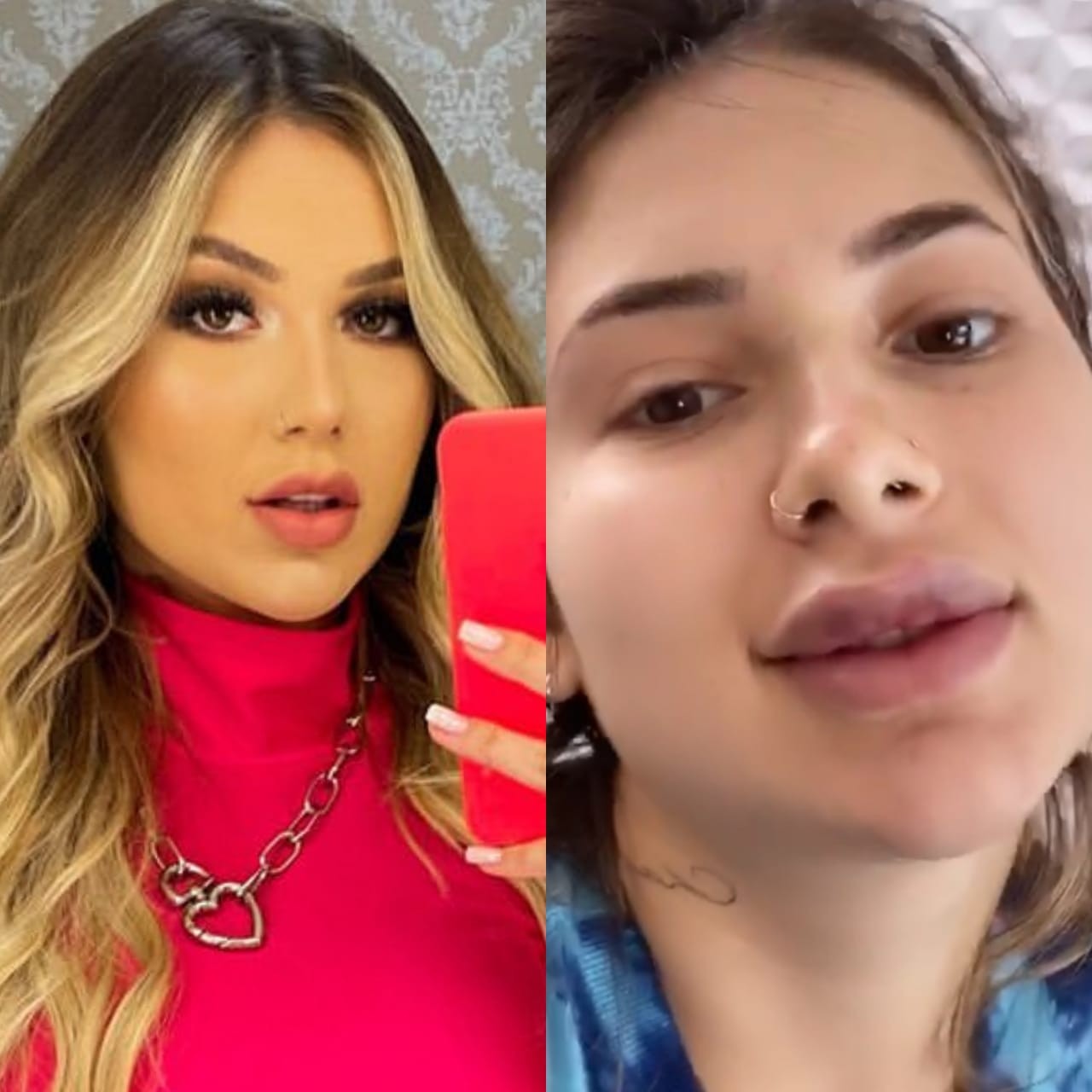 Virginia Fonseca antes e depois de procedimentos no rosto (Foto: Reprodução/Instagram)