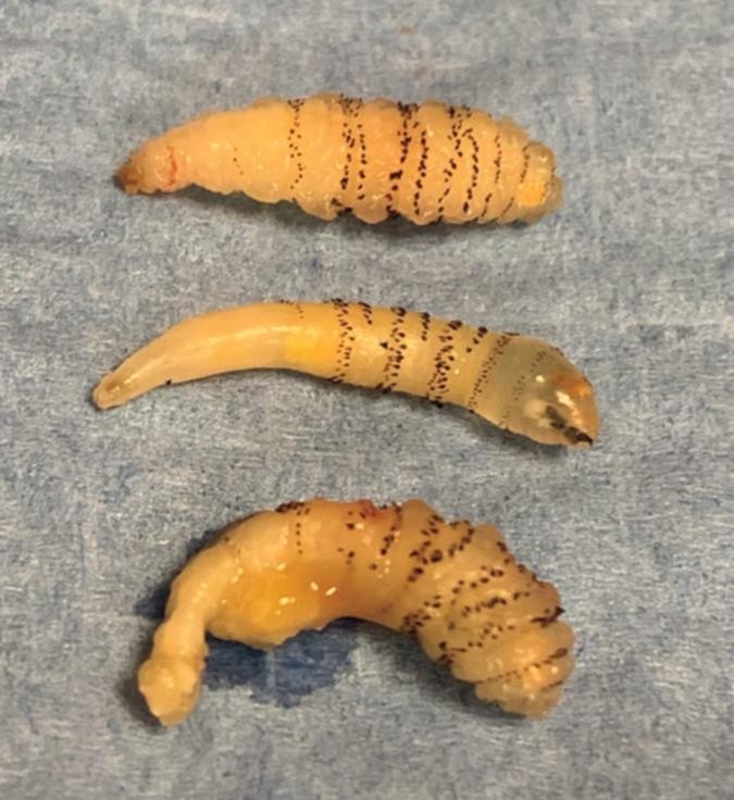 Larvas retiradas do corpo da paciente (Foto: New England Journal of Medicine)
