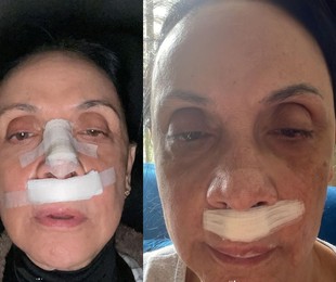 Cininha de Paula fraturou o nariz em acidente em set de filmagem | Reprodução