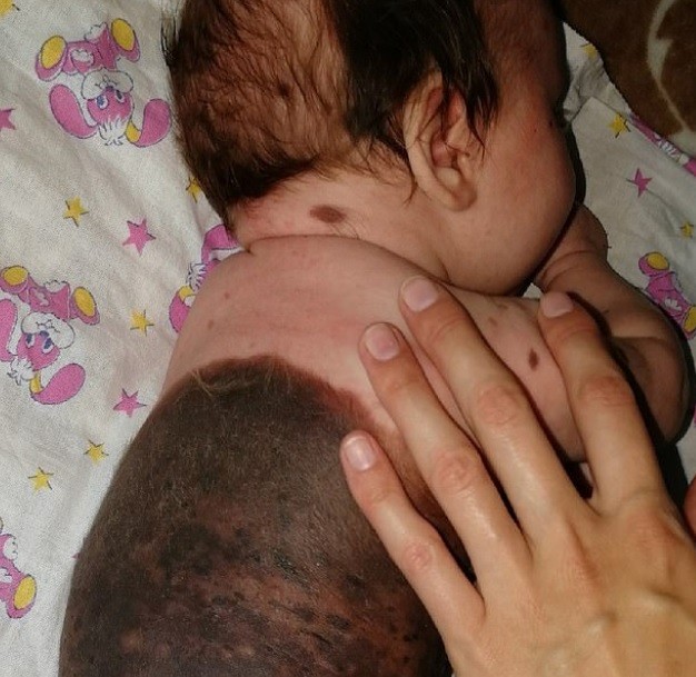 Bebê com mancha de nascença recebe comentários de ódio nas redes sociais (Foto: Reprodução )