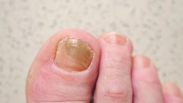 Unhas com micoses recorrentes (Foto: Getty images via BBC News Brasil)