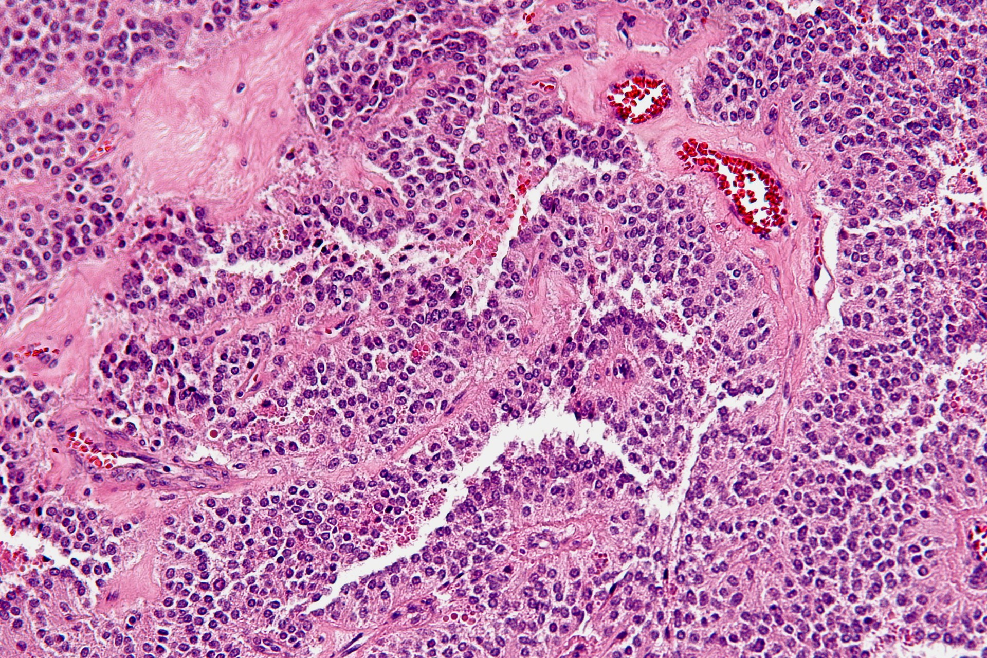 Microscopia de um câncer de pâncreas (Foto: wikimedia commons)