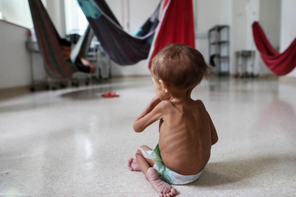 Criana Yanomami desnutrida  atendida no Hospital da Criana Santo Antnio, em Boa Vista, Roraima, Brasil, em 27 de janeiro de 2023 — Foto: Michael Dantas/AFP