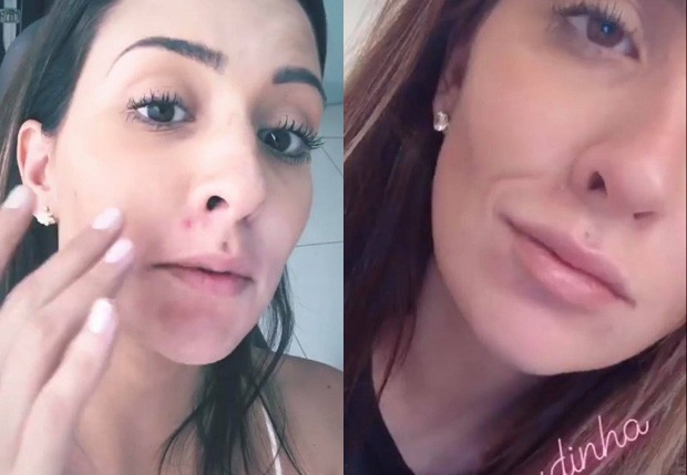 Tamires Peloso antes e depois do procedimento (Foto: Reprodução Instagram)