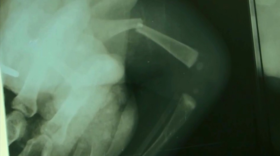 Raio X mostra fratura no recém-nascido  — Foto: Reprodução/TV Sudoeste