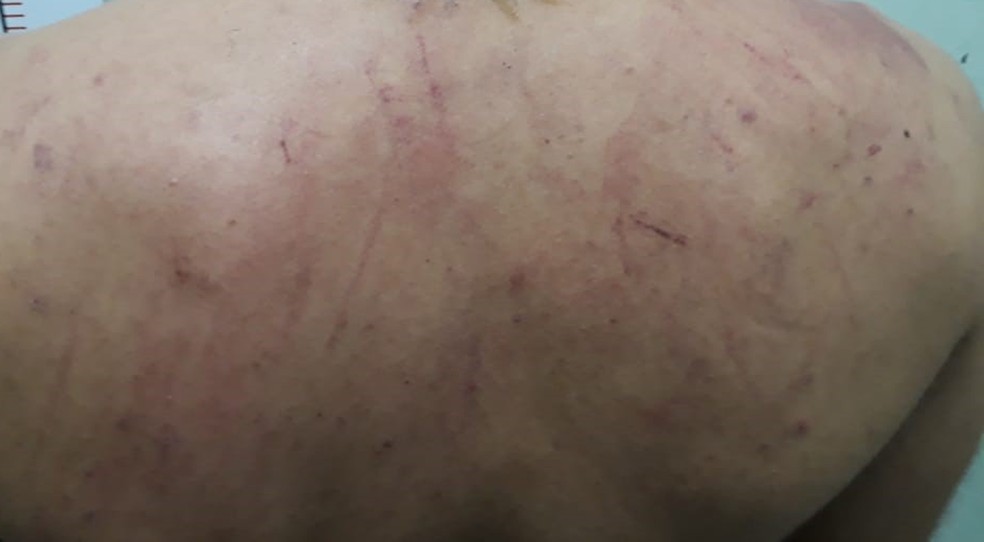 Indivíduo sofreu escoriações nas costas ao resistir à abordagem policial (Foto: Polícia Militar/Cedida)