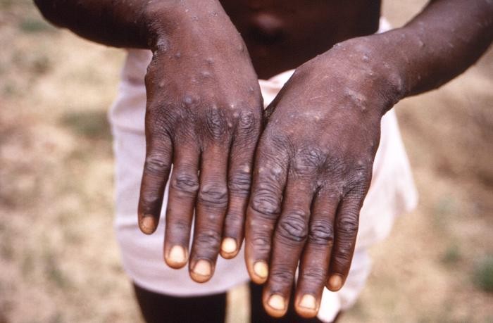 Esta imagem de 1997 foi criada durante uma investigação sobre um surto de varíola dos macacos, que ocorreu na República Democrática do Congo (RDC) (Foto: CDC/ Brian W.J. Mahy, BSc, MA, PhD, ScD, DSc)