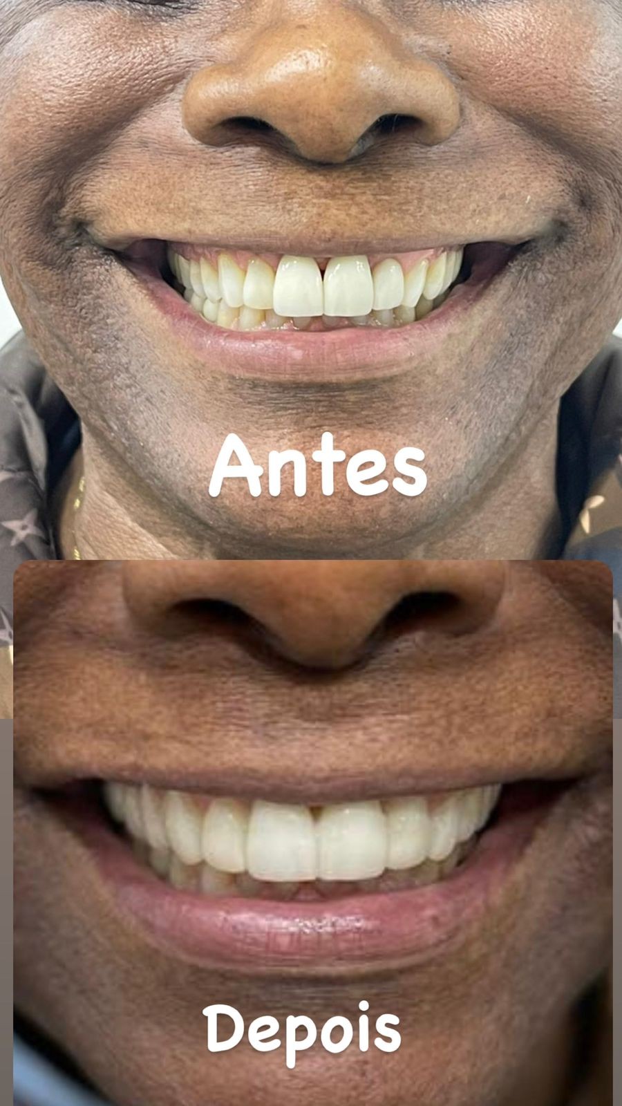Neguinho da Beija-Flor antes e depois de colocar as lentes de contato dentárias (Foto: Divulgação)