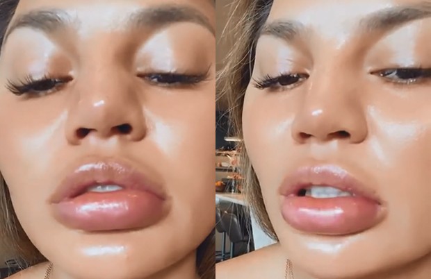 Chrissy Teigen fica com lábios inchados por alergia (Foto: Reprodução/Instagram)