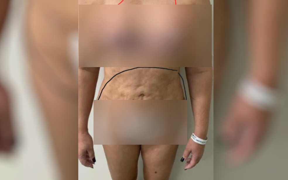 Mulher diz que ficou com cicatrizes na barriga e seios irregulares aps cirurgia com Lorena Rosique em Goinia, Gois  Foto: Arquivo pessoal/g1