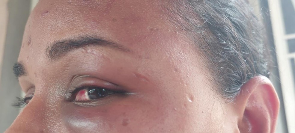 Mulher ficou com hematomas no rosto, braço, perna e costa. — Foto: Josney Benevenuto/Rede Amazônica