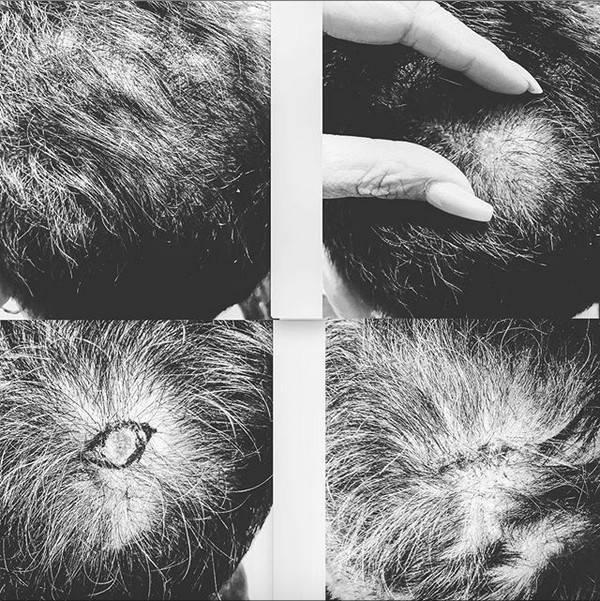 O post compartilhado por Julian Lennon, filho mais velho de John Lennon (1940-1980), revelando o tumor encontrado e removido de sua cabeça  (Foto: Instagram)