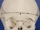 Moldes que imitam osso humano aceleram cirurgias de crânio e face