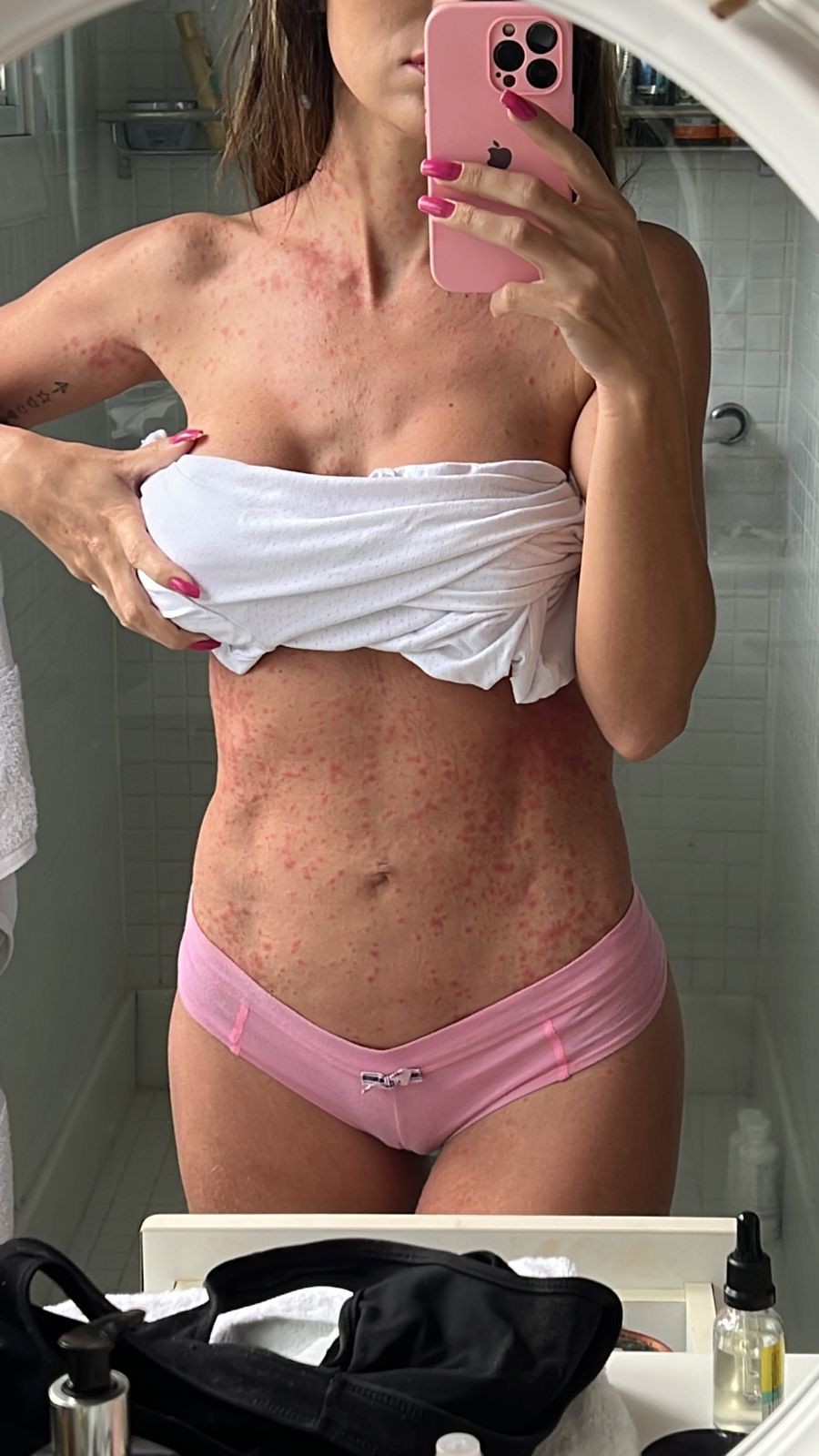 Leticia Santiago mostra inflamação no corpo (Foto: Reprodução/Instagram)