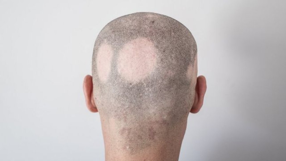 Pacientes com predisposição genética ou doenças autoimunes, por exemplo, que podem apresentar quedas em forma de rodelas, condição conhecida como alopecia areata — Foto: Getty Images via BBC