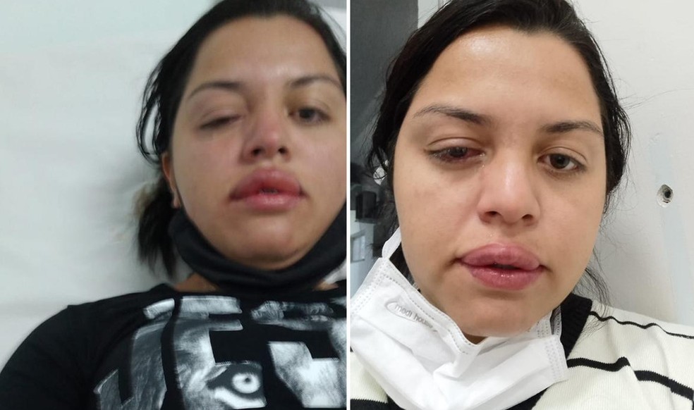 Faxineira atacada pelo ex-patrão com ácido teme perder visão de um olho: 'Não consigo enxergar'